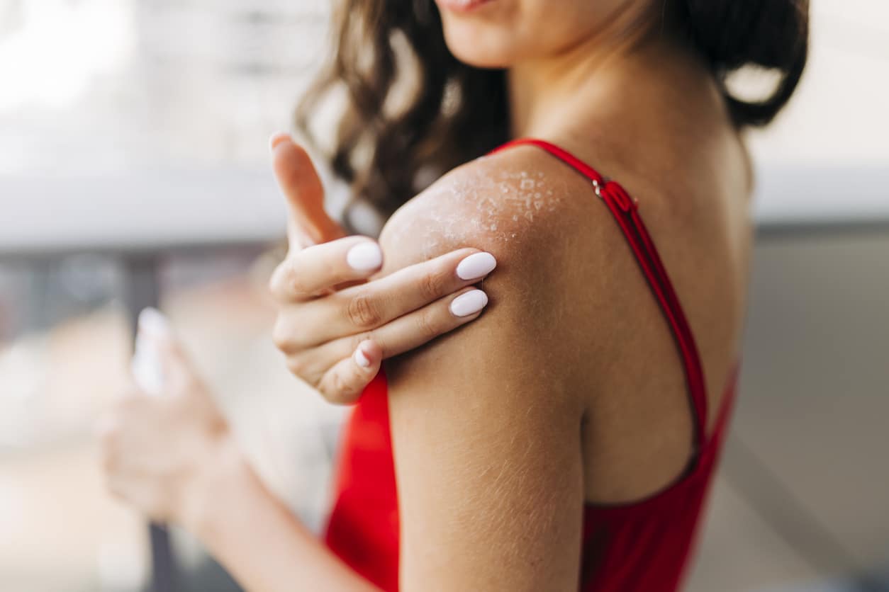 Woman experiencing dermatitis touching her shoulder.
