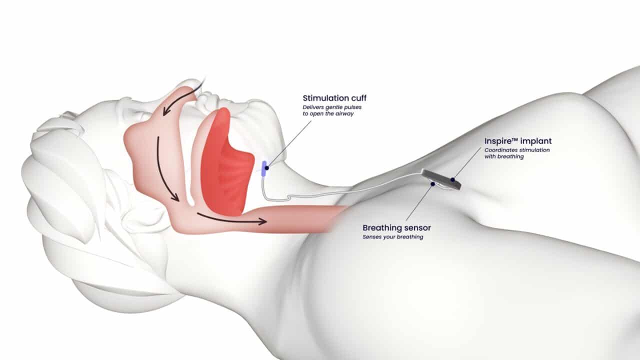 Inspire® Therapy for Obstructive Sleep Apnea | North Alabama ENT Associates
